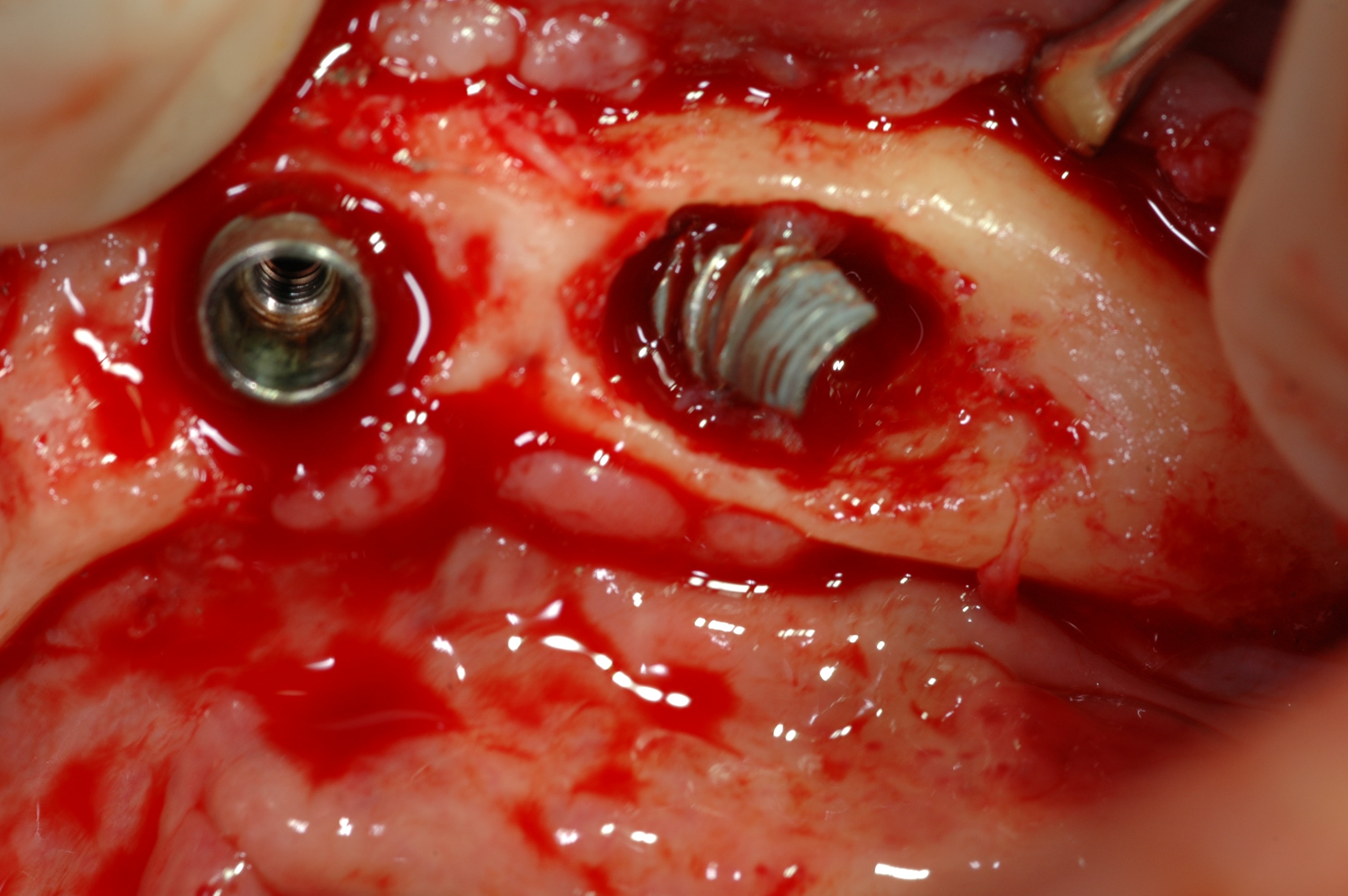 Dental implants broken inside the bone