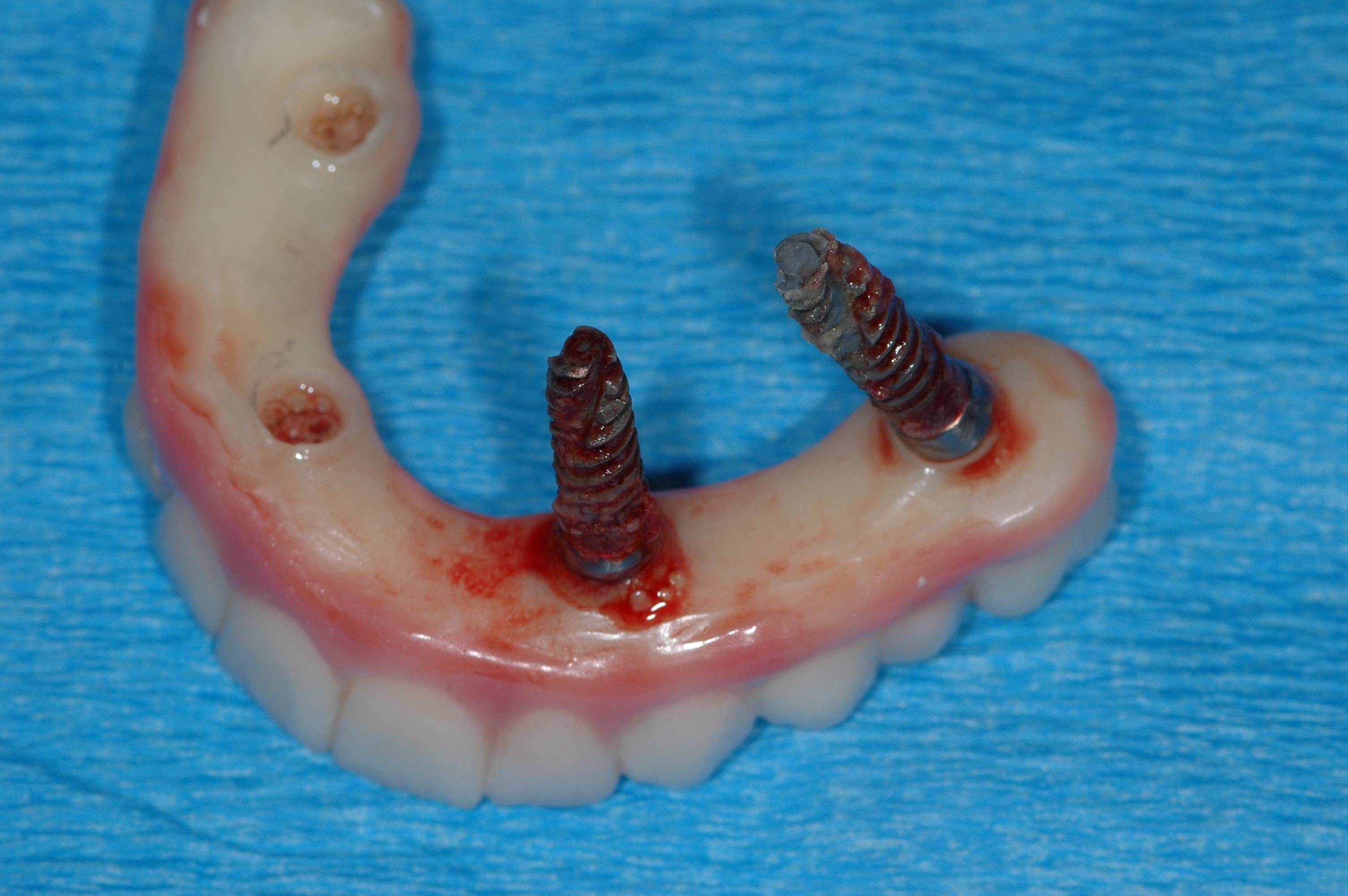 Lower dental implant prosthesis with exposed implants