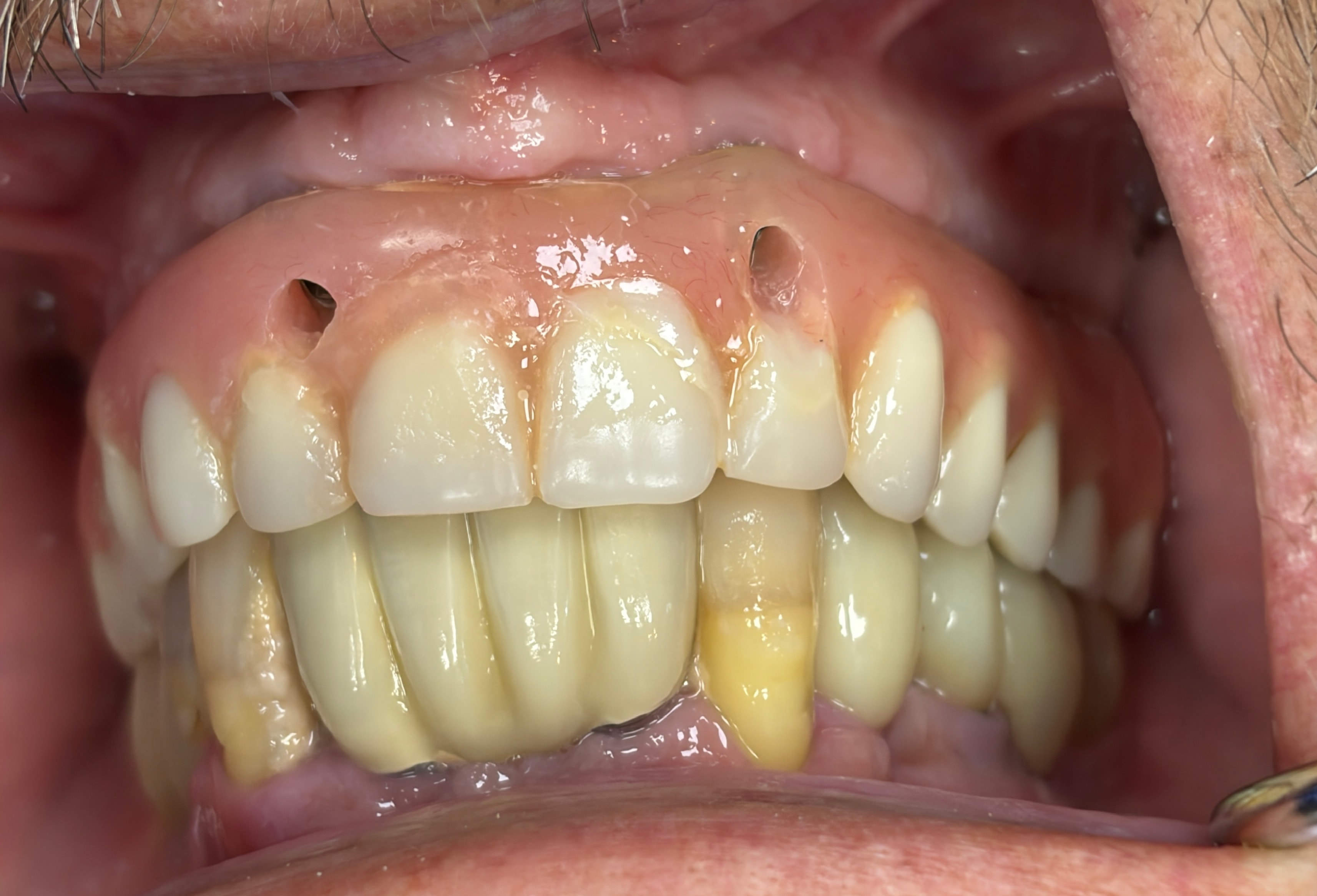 Unesthetic upper All-on-4 due to incorrect implant placement