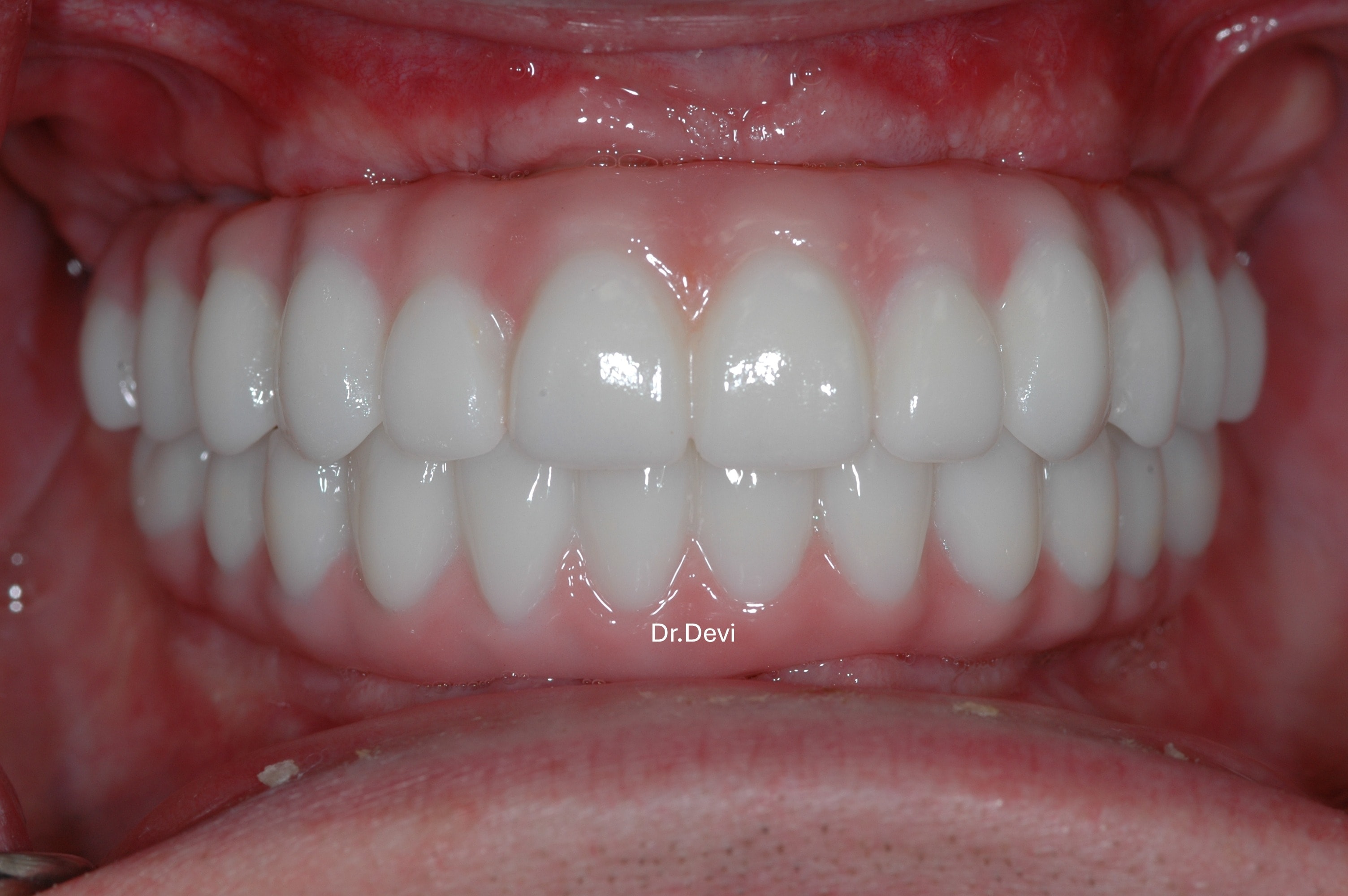 All-on-4 Dental Implants
